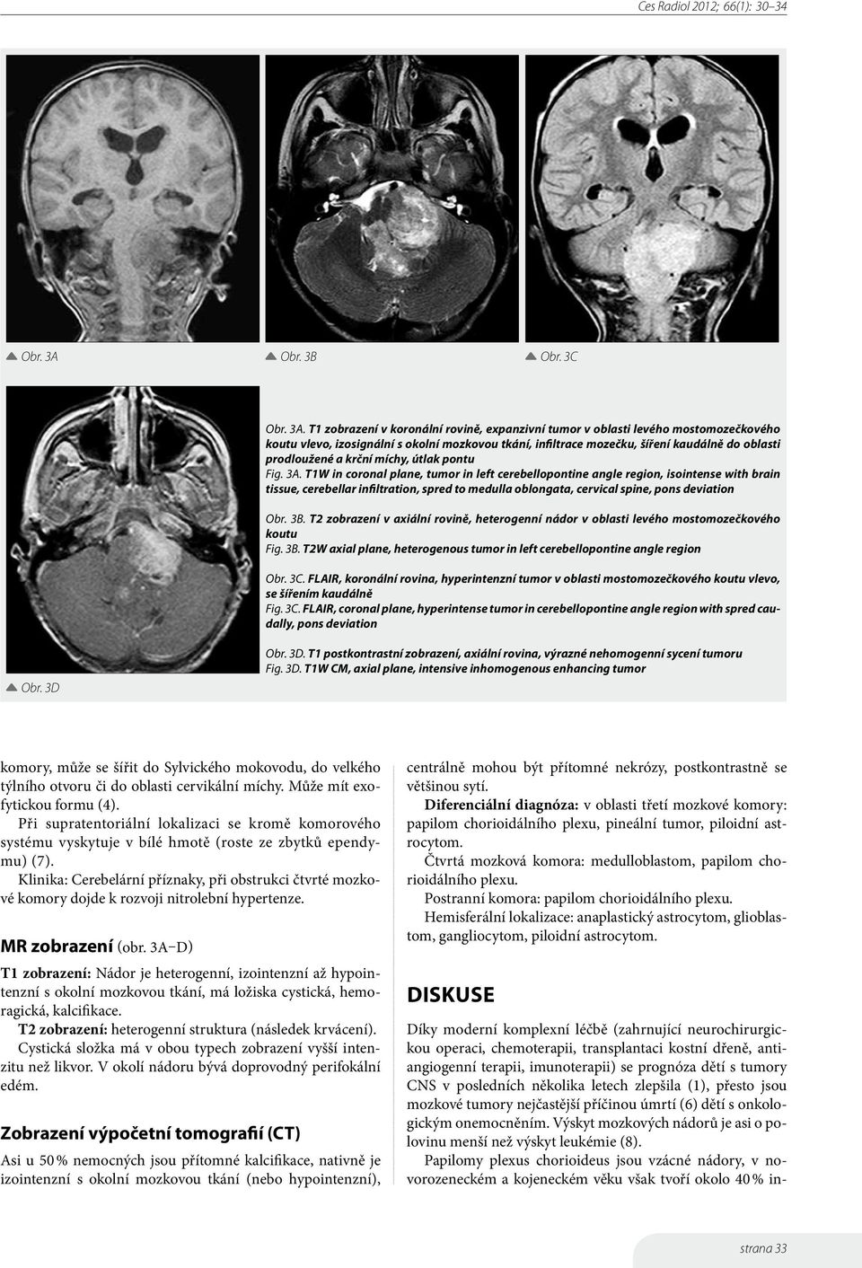 T1 zobrazení v koronální rovině, expanzivní tumor v oblasti levého mostomozečkového koutu vlevo, izosignální s okolní mozkovou tkání, infiltrace mozečku, šíření kaudálně do oblasti prodloužené a