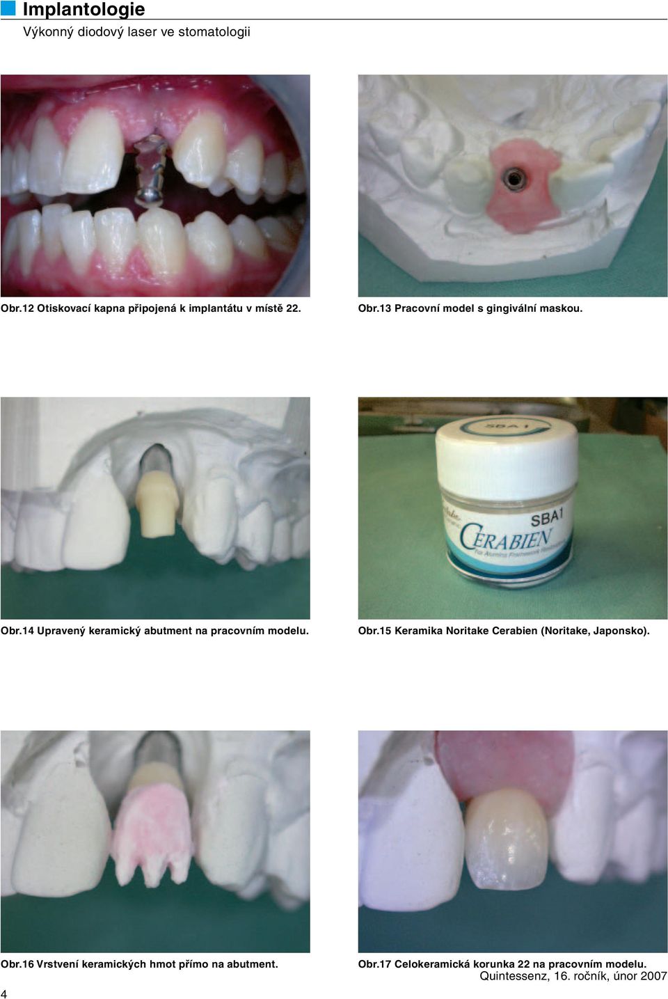 14 Upravený keramický abutment na pracovním modelu. Obr.