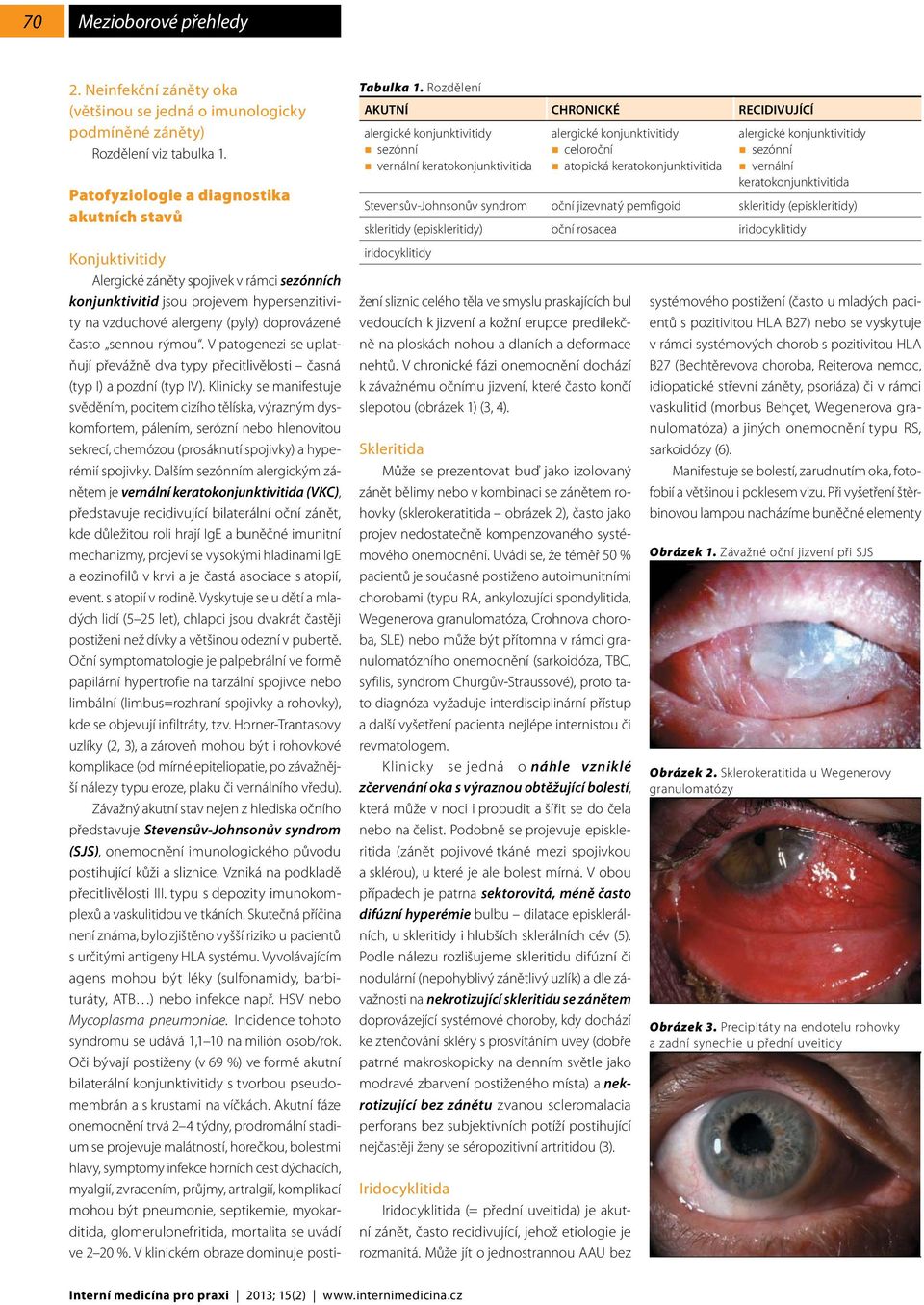 jizevnatý pemfigoid skleritidy (episkleritidy) skleritidy (episkleritidy) oční rosacea iridocyklitidy iridocyklitidy Konjuktivitidy Alergické záněty spojivek v rámci sezónních konjunktivitid jsou
