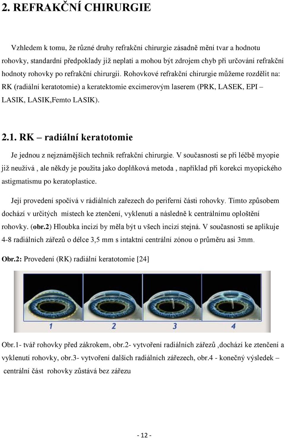 RK radiální keratotomie Je jednou z nejznámějších technik refrakční chirurgie.