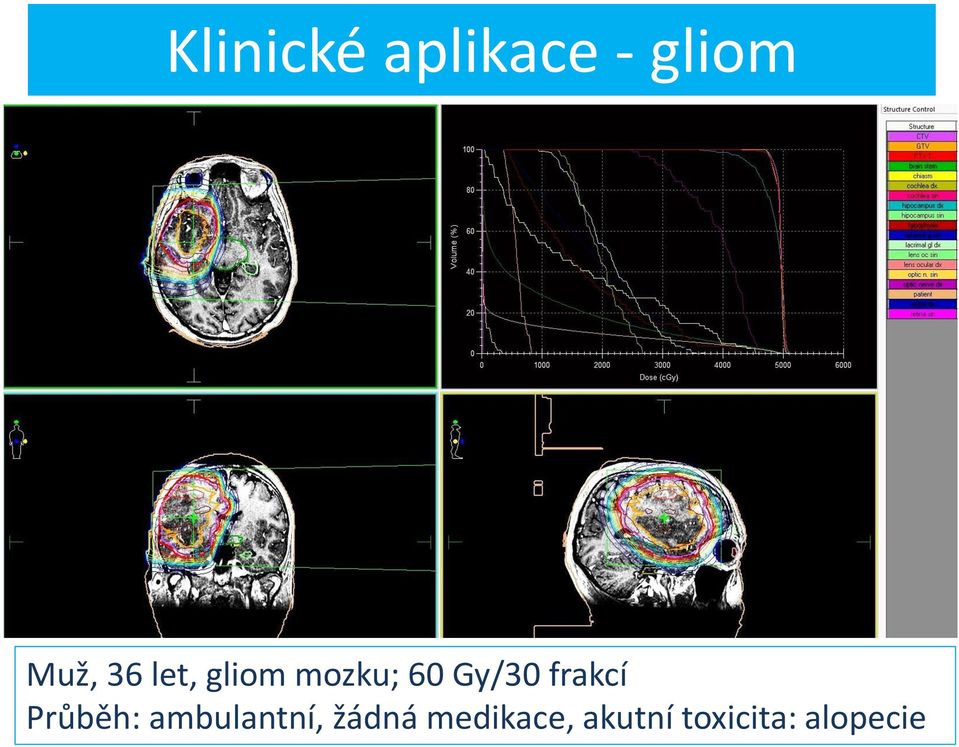 frakcí Průběh: ambulantní, žádná