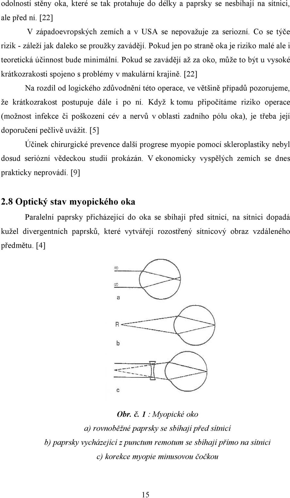 Pokud se zavádějí až za oko, může to být u vysoké krátkozrakosti spojeno s problémy v makulární krajině.