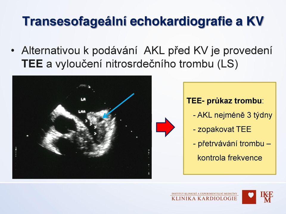 nitrosrdečního trombu (LS) TEE- průkaz trombu: - AKL