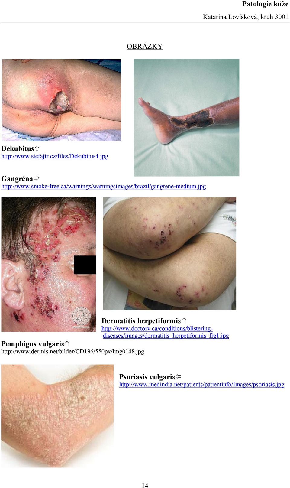 ca/conditions/blisteringdiseases/images/dermatitis_herpetiformis_fig1.jpg Pemphigus vulgaris http://www.