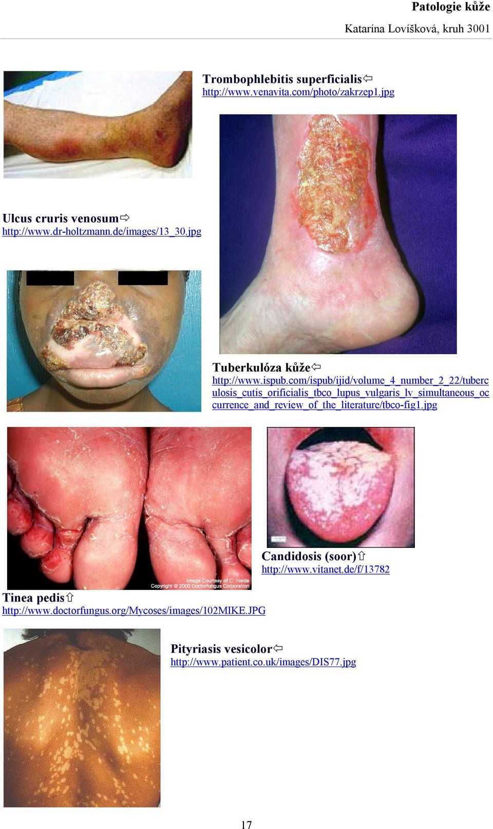 com/ispub/ijid/volume_4_number_2_22/tuberc ulosis_cutis_orificialis_tbco_lupus_vulgaris_lv_simultaneous_oc