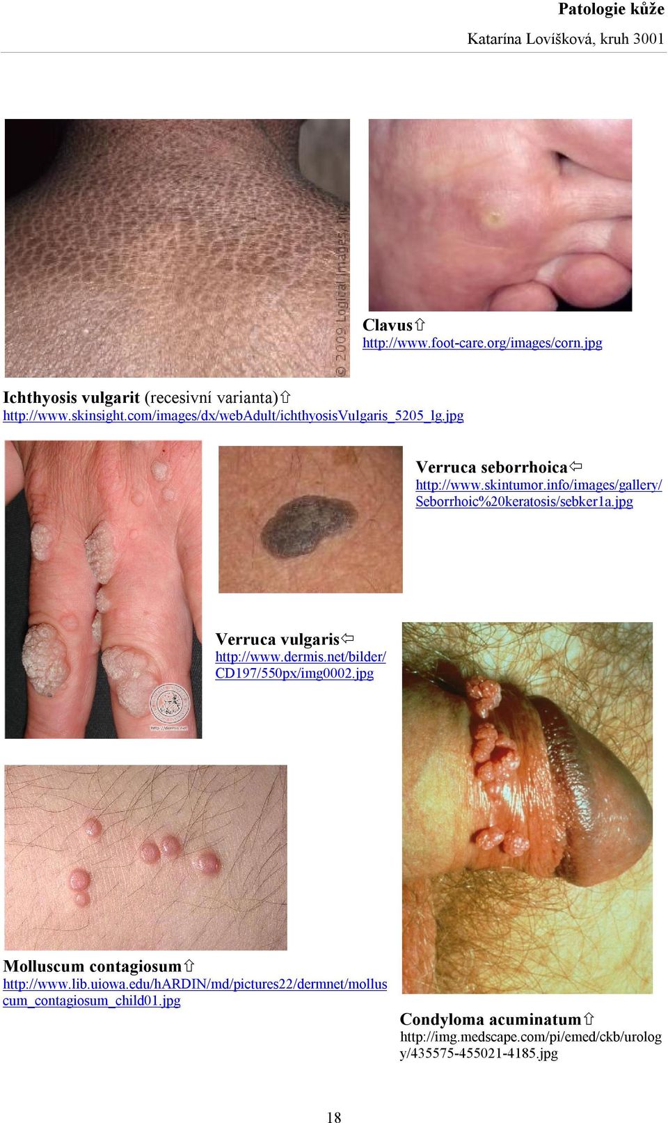 info/images/gallery/ Seborrhoic%20keratosis/sebker1a.jpg Verruca vulgaris http://www.dermis.net/bilder/ CD197/550px/img0002.