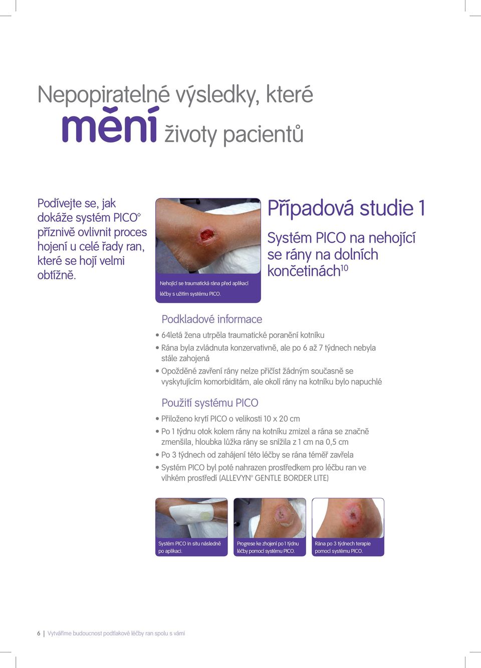 Případová studie 1 Systém PICO na nehojící se rány na dolních končetinách 10 Podkladové informace 64letá žena utrpěla traumatické poranění kotníku Rána byla zvládnuta konzervativně, ale po 6 až 7