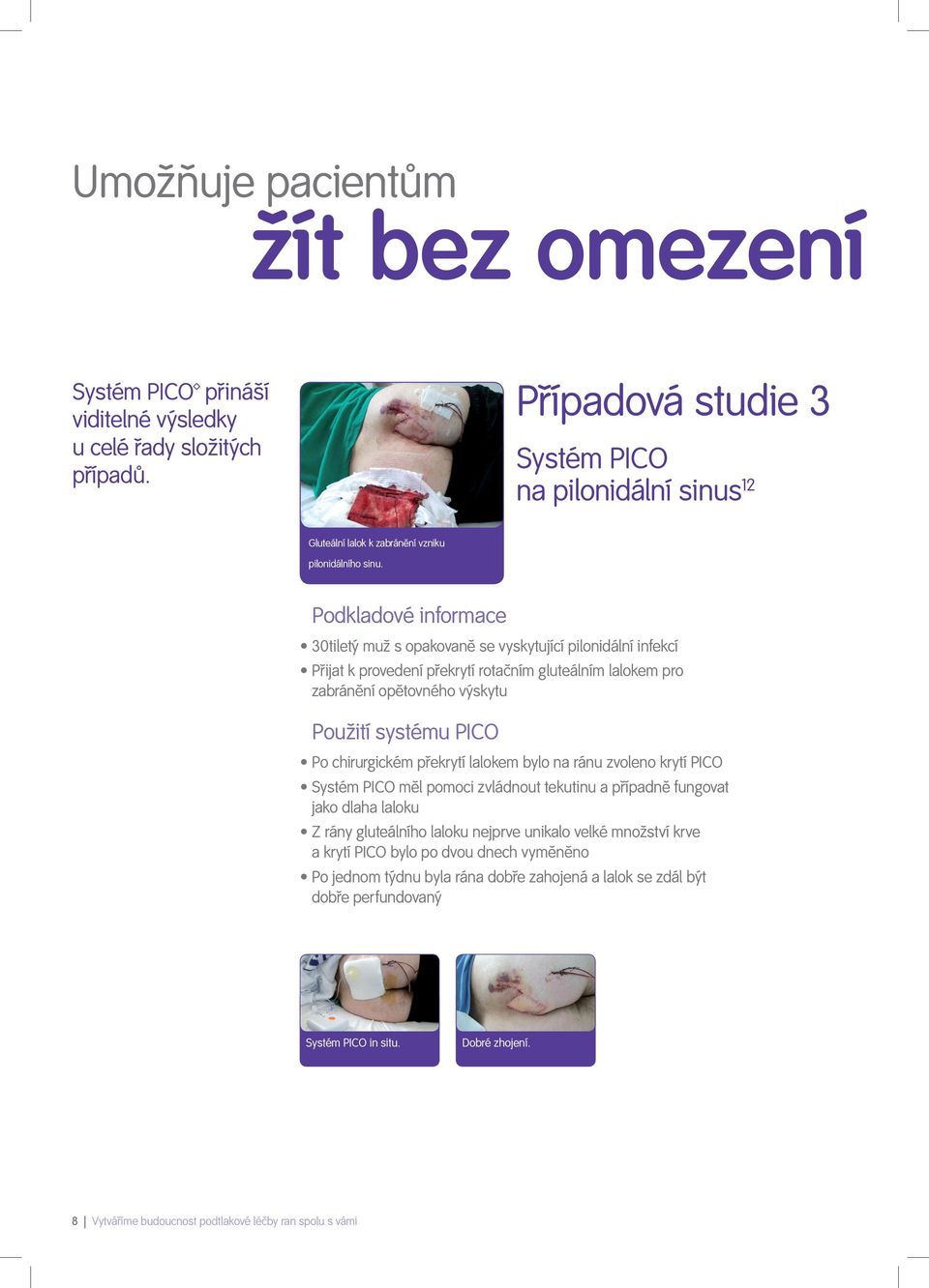 Podkladové informace 30tiletý muž s opakovaně se vyskytující pilonidální infekcí Přijat k provedení překrytí rotačním gluteálním lalokem pro zabránění opětovného výskytu Použití systému PICO Po