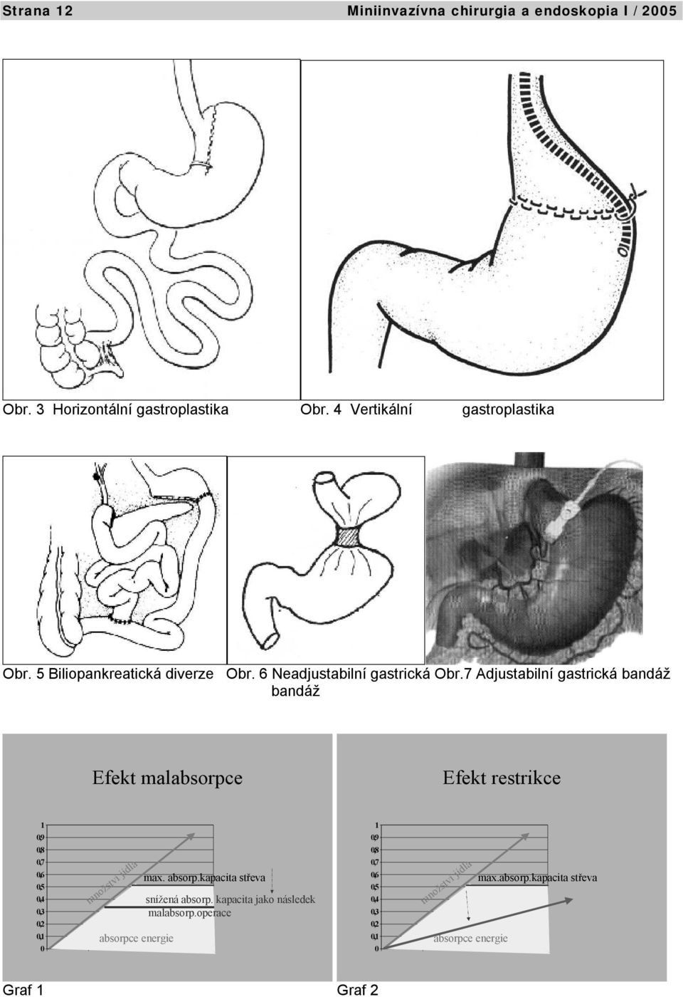 7 Adjustabilní gastrická bandáž bandáž Efekt malabsorpce Efekt restrikce 1 0,9 0,8 0,7 0,6 0,5 0,4 0,3 0,2 0,1 0 množství jídla