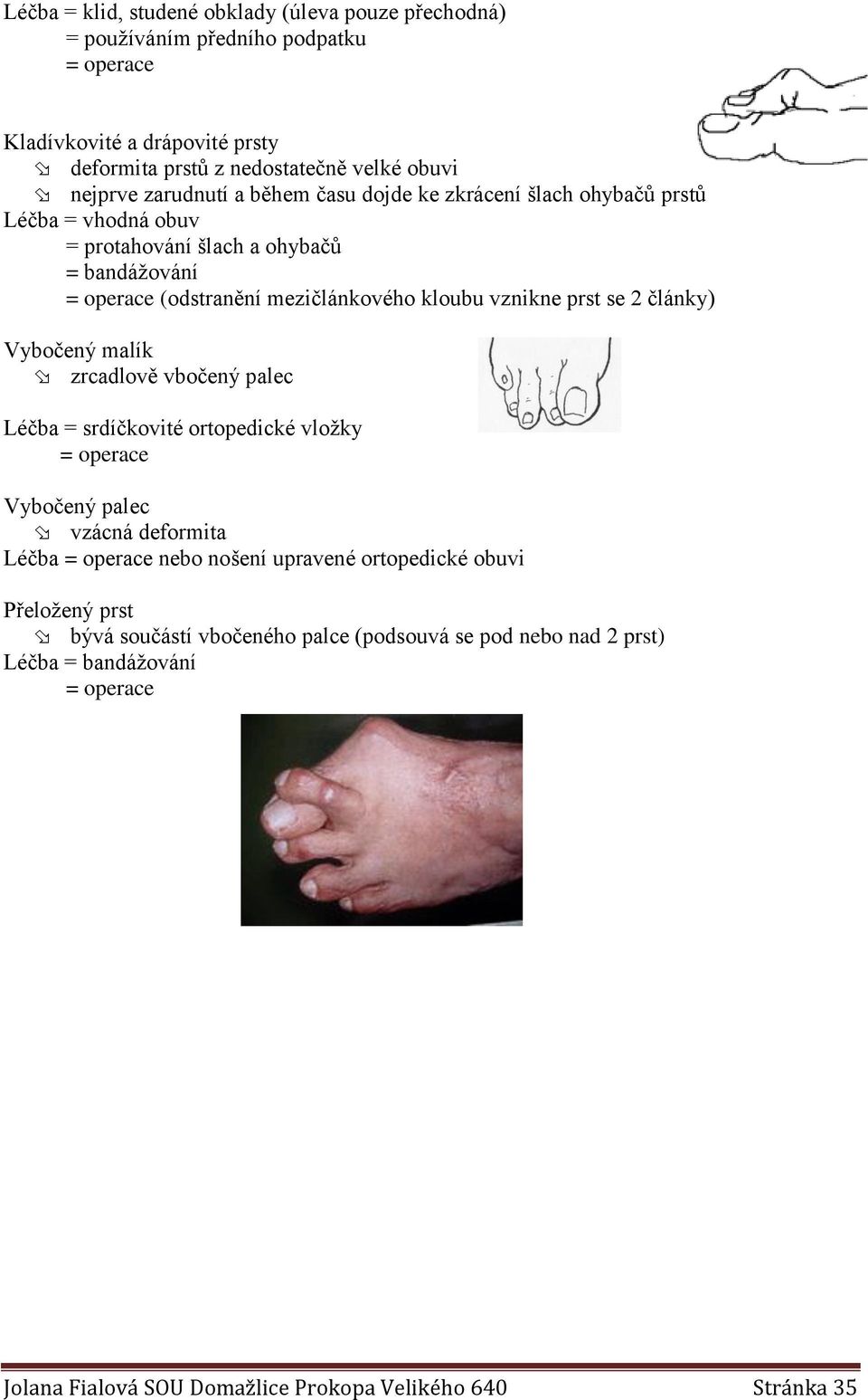 prst se 2 články) Vybočený malík zrcadlově vbočený palec Léčba = srdíčkovité ortopedické vložky Vybočený palec vzácná deformita Léčba nebo nošení upravené ortopedické