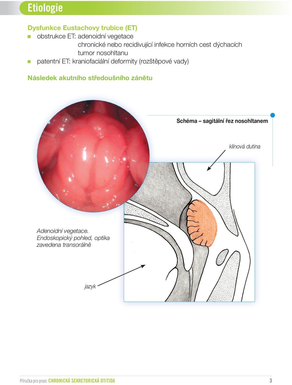 Následek akutního středoušního zánětu Schéma sagitální řez nosohltanem klínová dutina Adenoidní vegetace.