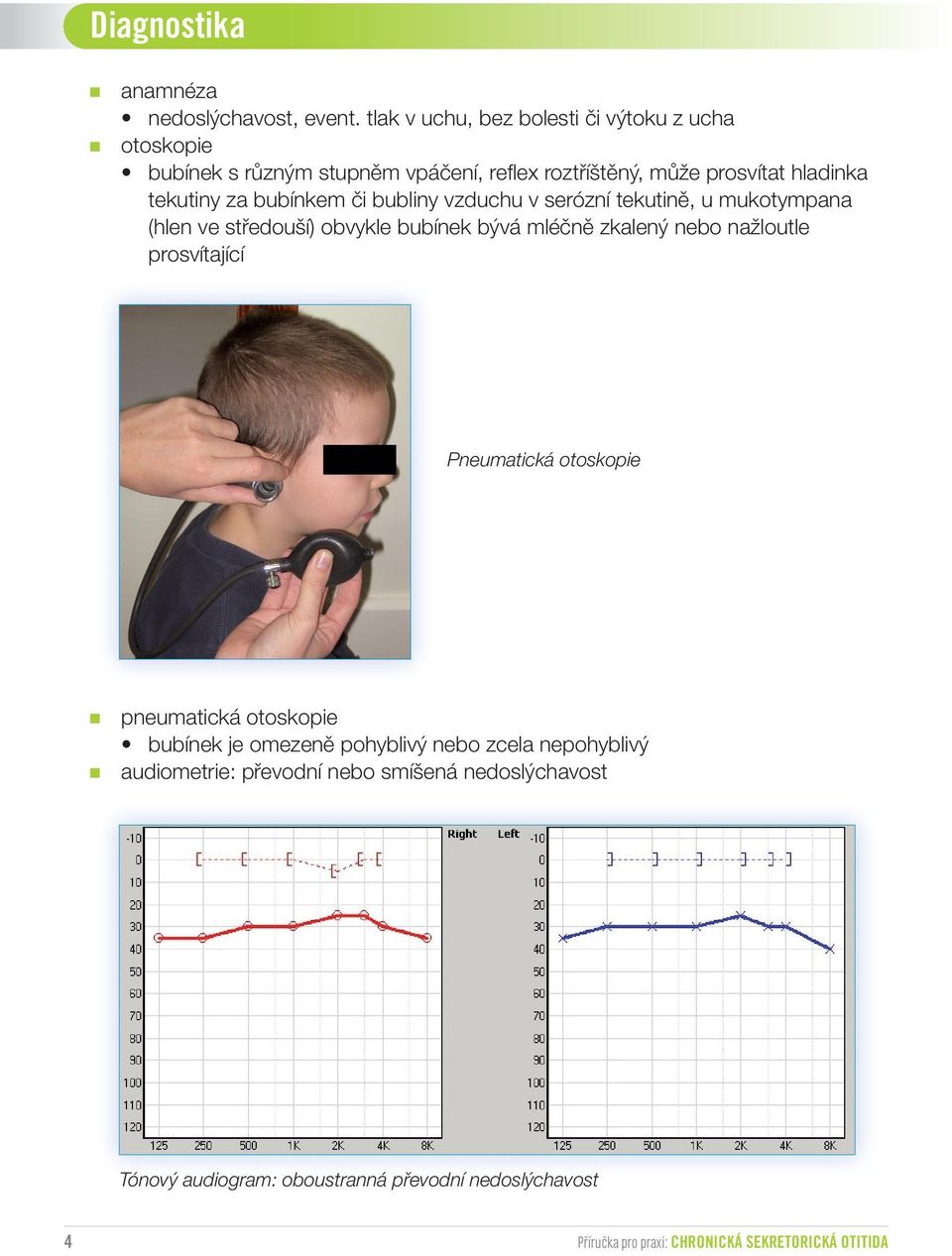 bubínkem či bubliny vzduchu v serózní tekutině, u mukotympana (hlen ve středouší) obvykle bubínek bývá mléčně zkalený nebo nažloutle prosvítající