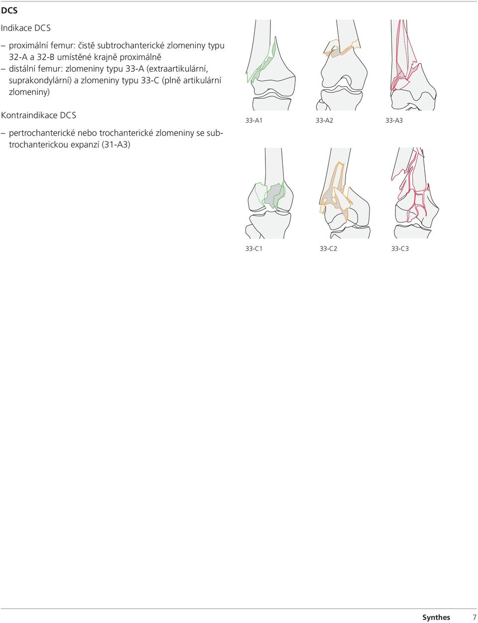 zlomeniny typu 33-C (plně artikulární zlomeniny) Kontraindikace DCS pertrochanterické nebo