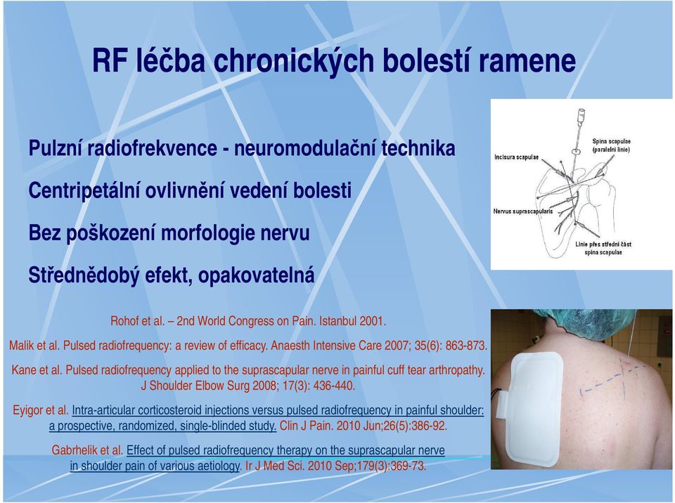 Pulsed radiofrequency applied to the suprascapular nerve in painful cuff tear arthropathy. J Shoulder Elbow Surg 2008; 17(3): 436-440. Eyigor et al.