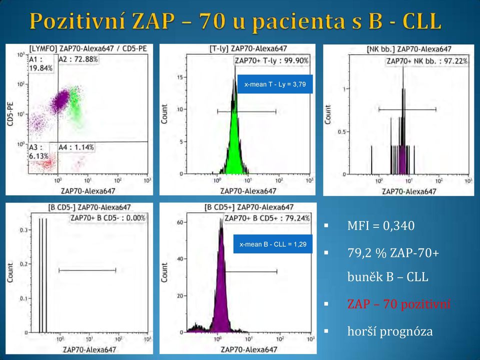 79,2 % ZAP-70+ buněk B CLL