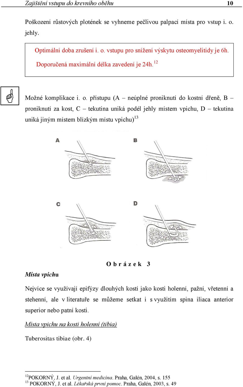 přístupu (A neúplné proniknutí do kostní dřeně, B proniknutí za kost, C tekutina uniká podél jehly místem vpichu, D tekutina uniká jiným místem blízkým místu vpichu) 13 Místa vpichu O b r á z e k 3