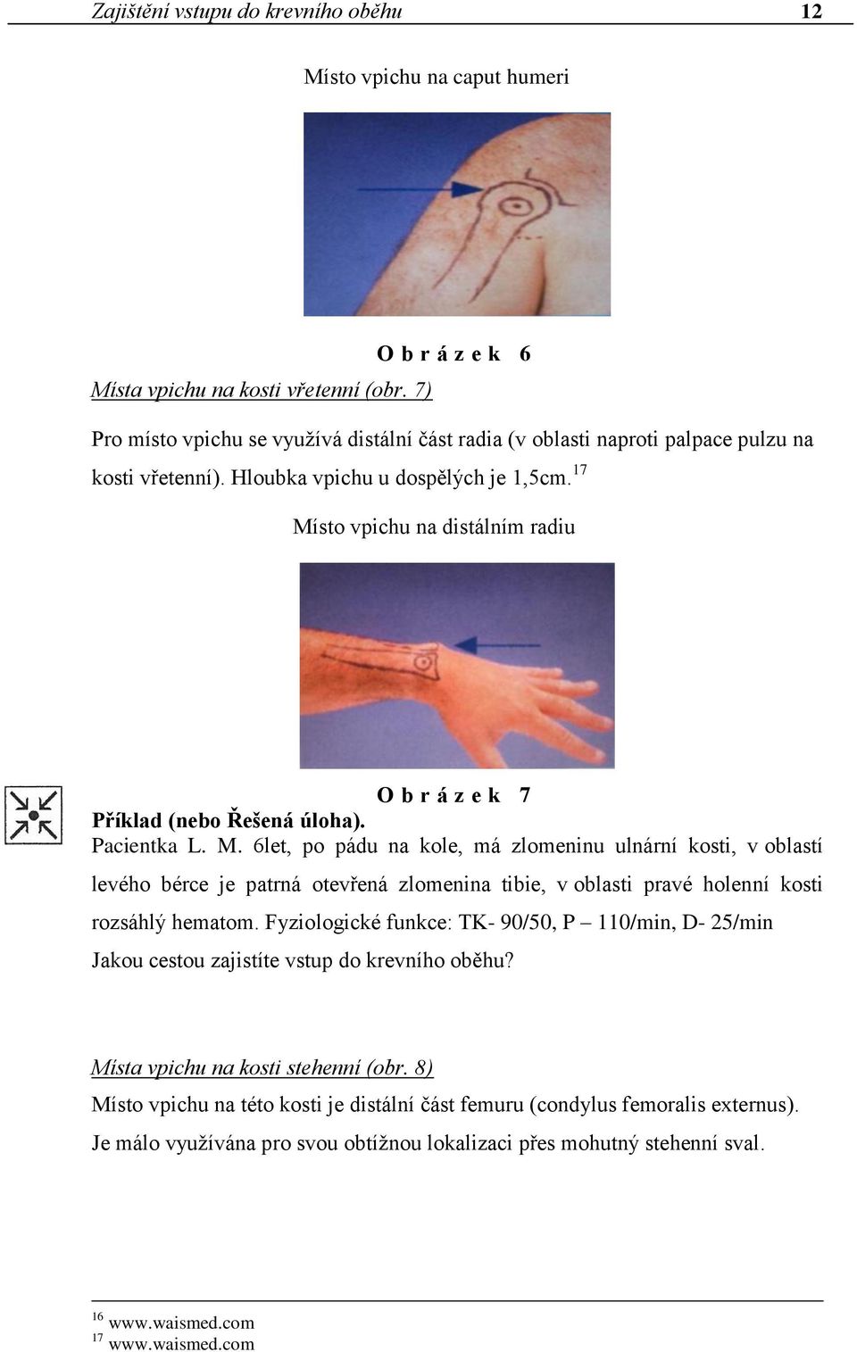 17 Místo vpichu na distálním radiu O b r á z e k 7 Příklad (nebo Řešená úloha). Pacientka L. M. 6let, po pádu na kole, má zlomeninu ulnární kosti, v oblastí levého bérce je patrná otevřená zlomenina tibie, v oblasti pravé holenní kosti rozsáhlý hematom.