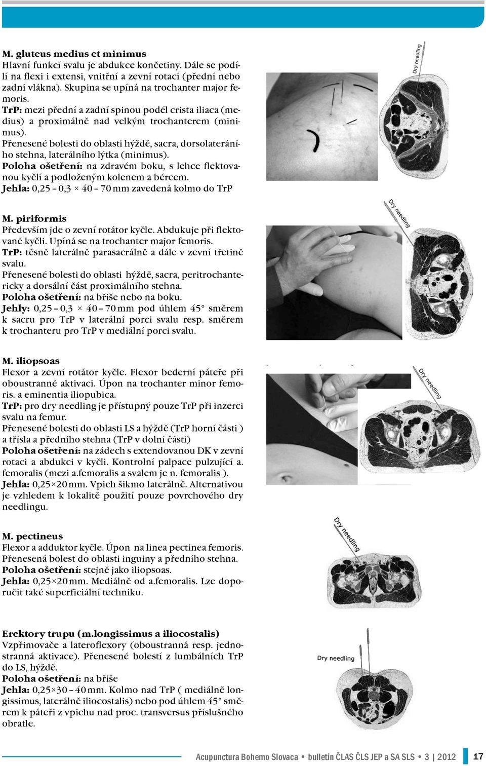 Přenesené bolesti do oblasti hýždě, sacra, dorsolateráního stehna, laterálního lýtka (minimus). Poloha ošetření: na zdravém boku, s lehce flektovanou kyčlí a podloženým kolenem a bércem.