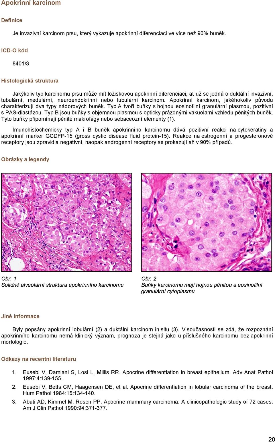 karcinom. Apokrinní karcinom, jakéhokoliv původu charakterizují dva typy nádorových buněk. Typ A tvoří buňky s hojnou eosinofilní granulární plasmou, pozitivní s PAS-diastázou.