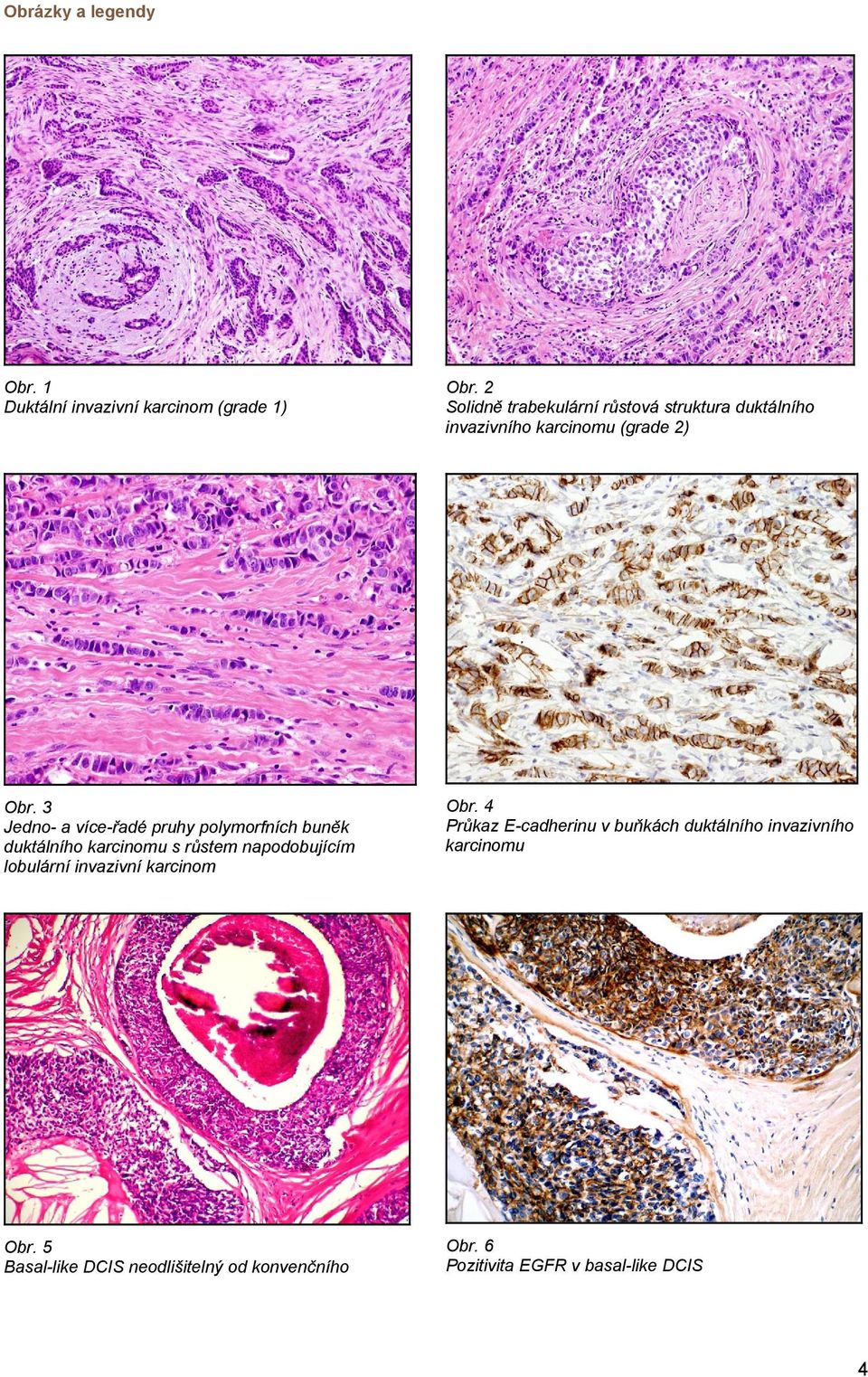 3 Jedno- a více-řadé pruhy polymorfních buněk duktálního karcinomu s růstem napodobujícím lobulární invazivní