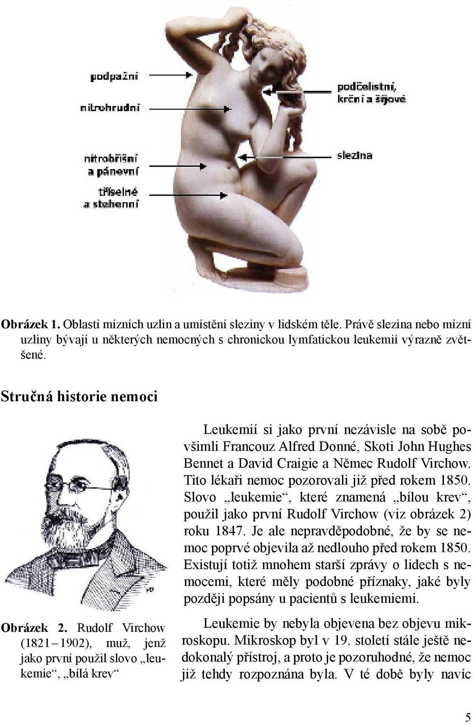 Rudolf Virchow (1821 1902), muž, jenž jako první použil slovo leukemie, bílá krev Leukemií si jako první nezávisle na sobě povšimli Francouz Alfred Donné, Skoti John Hughes Bennet a David Craigie a