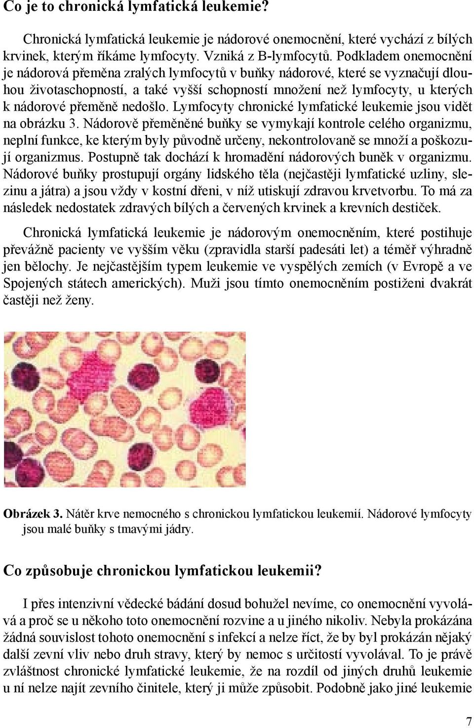 nedošlo. Lymfocyty chronické lymfatické leukemie jsou vidět na obrázku 3.