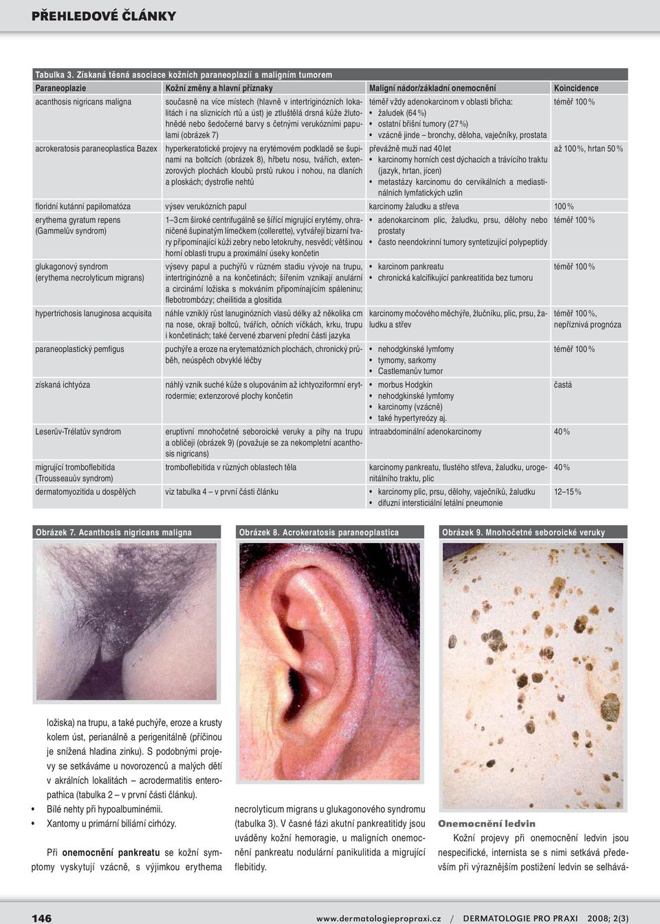 místech (hlavně v intertriginózních lokalitách i na sliznicích rtů a úst) je ztluštělá drsná kůže žlutohnědé nebo šedočerné barvy s četnými verukózními papulami (obrázek 7) téměř vždy adenokarcinom v