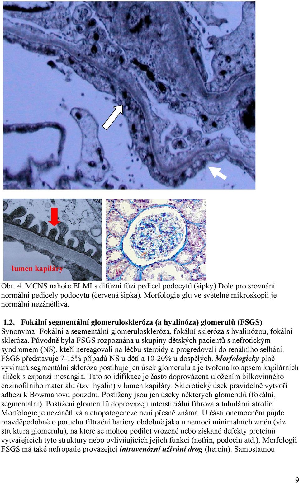 Fokální segmentální glomeruloskleróza (a hyalinóza) glomerulů (FSGS) Synonyma: Fokální a segmentální glomeruloskleróza, fokální skleróza s hyalinózou, fokální skleróza.