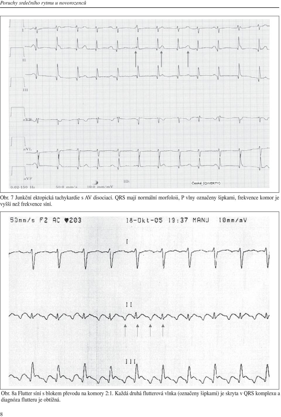 QRS mají normální morfoloii, P vlny označeny šipkami, frekvence komor je vyšší než