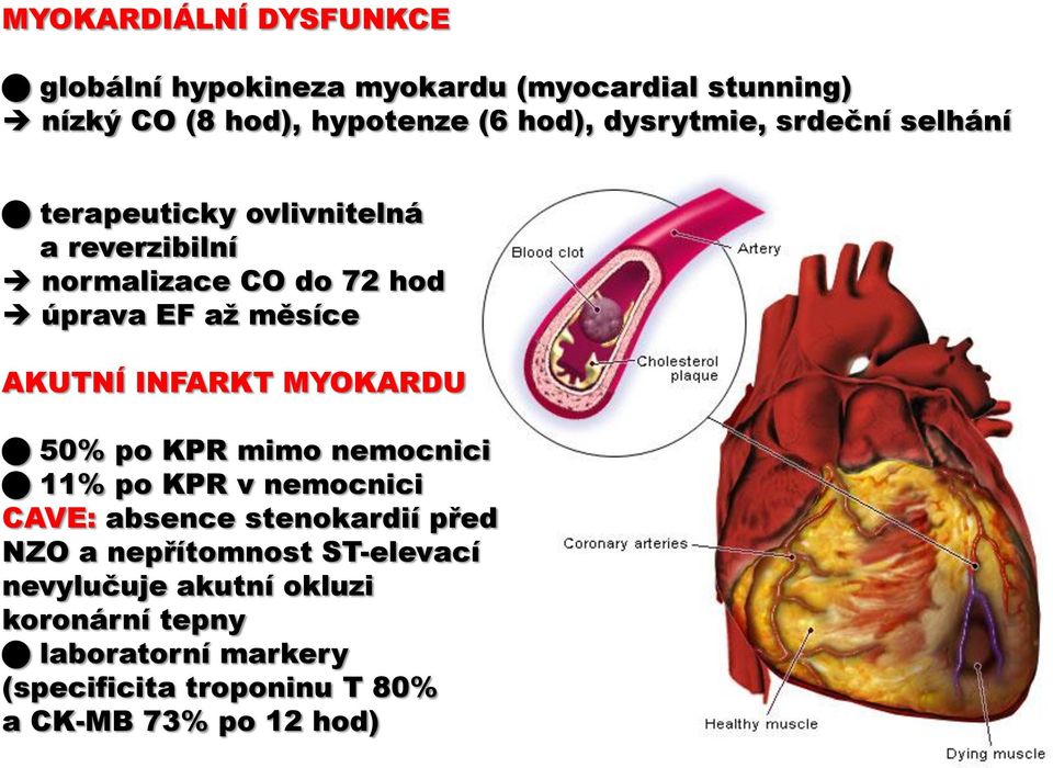 AKUTNÍ INFARKT MYOKARDU 50% po KPR mimo nemocnici 11% po KPR v nemocnici CAVE: absence stenokardií před NZO a