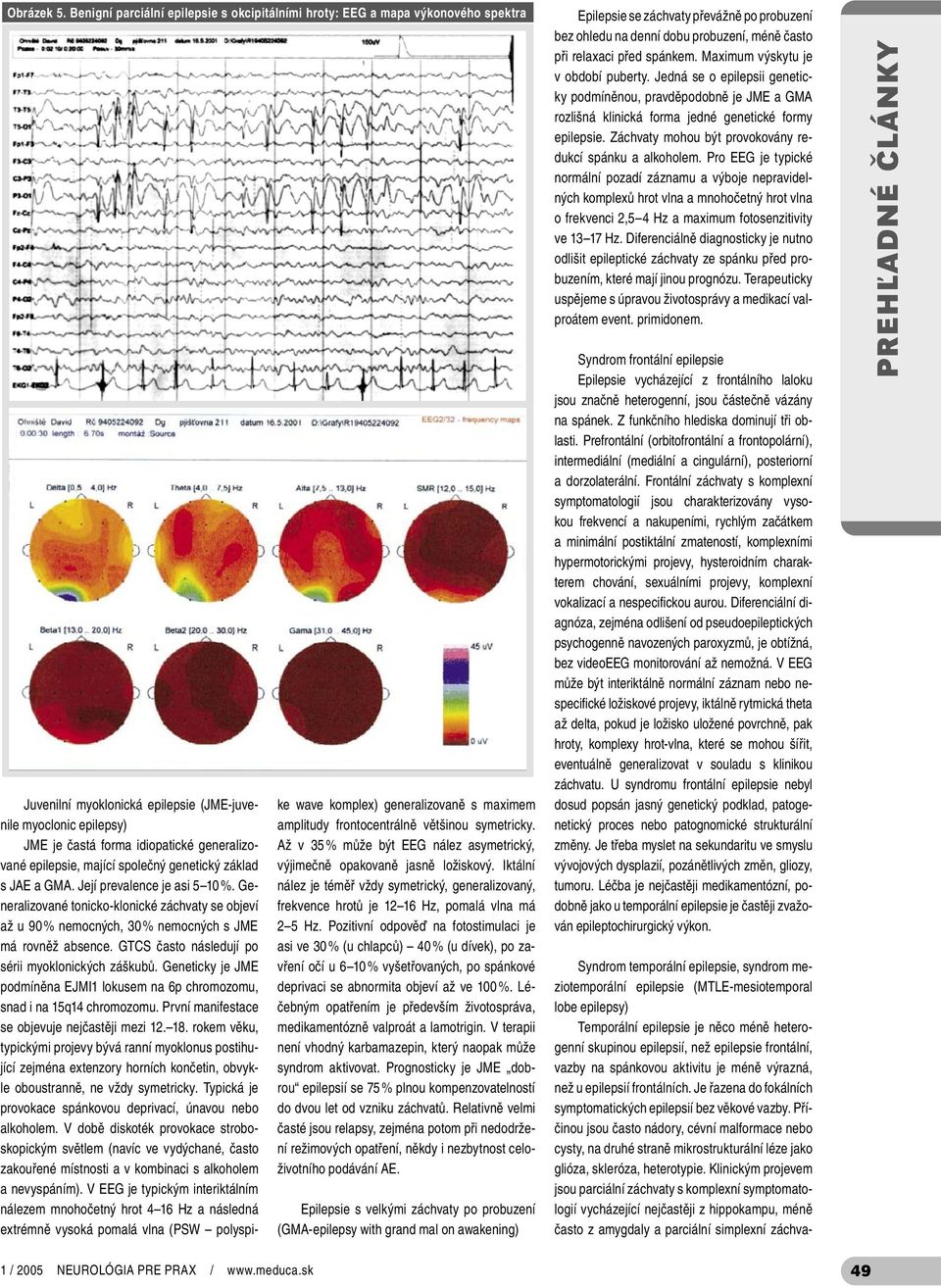 epilepsie, mající společný genetický základ s JAE a GMA. Její prevalence je asi 5 10 %. Generalizované tonicko-klonické záchvaty se objeví až u 90 % nemocných, 30 % nemocných s JME má rovněž absence.