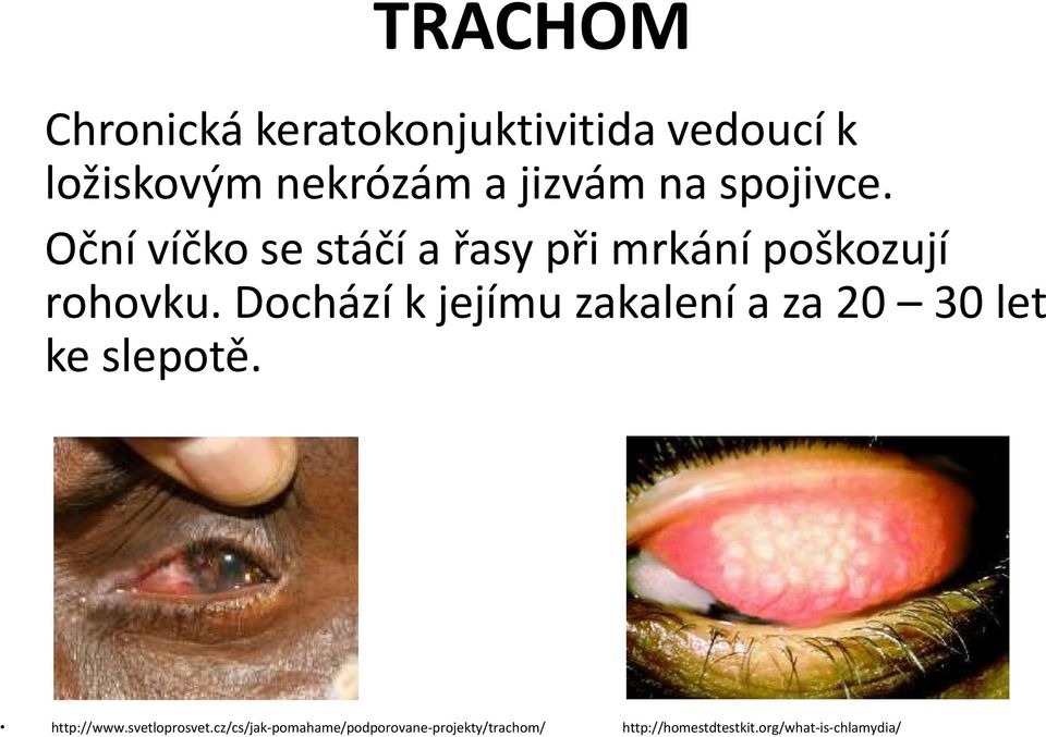 Dochází k jejímu zakalení a za 20 30 let ke slepotě. http://www.svetloprosvet.