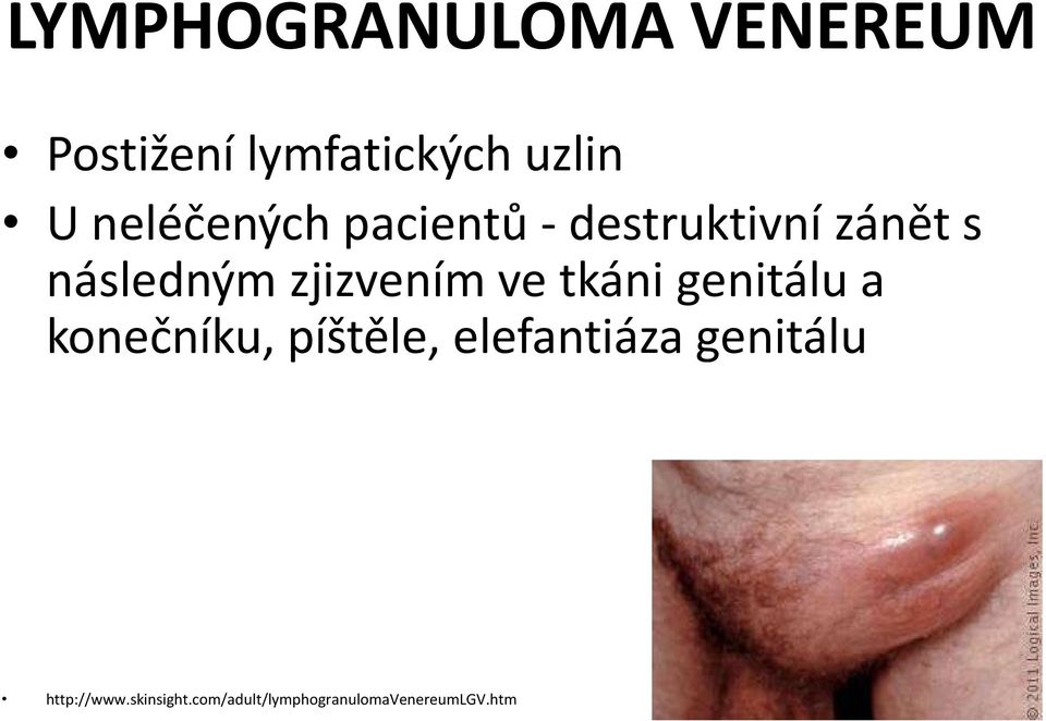 zjizvením ve tkáni genitálu a konečníku, píštěle,