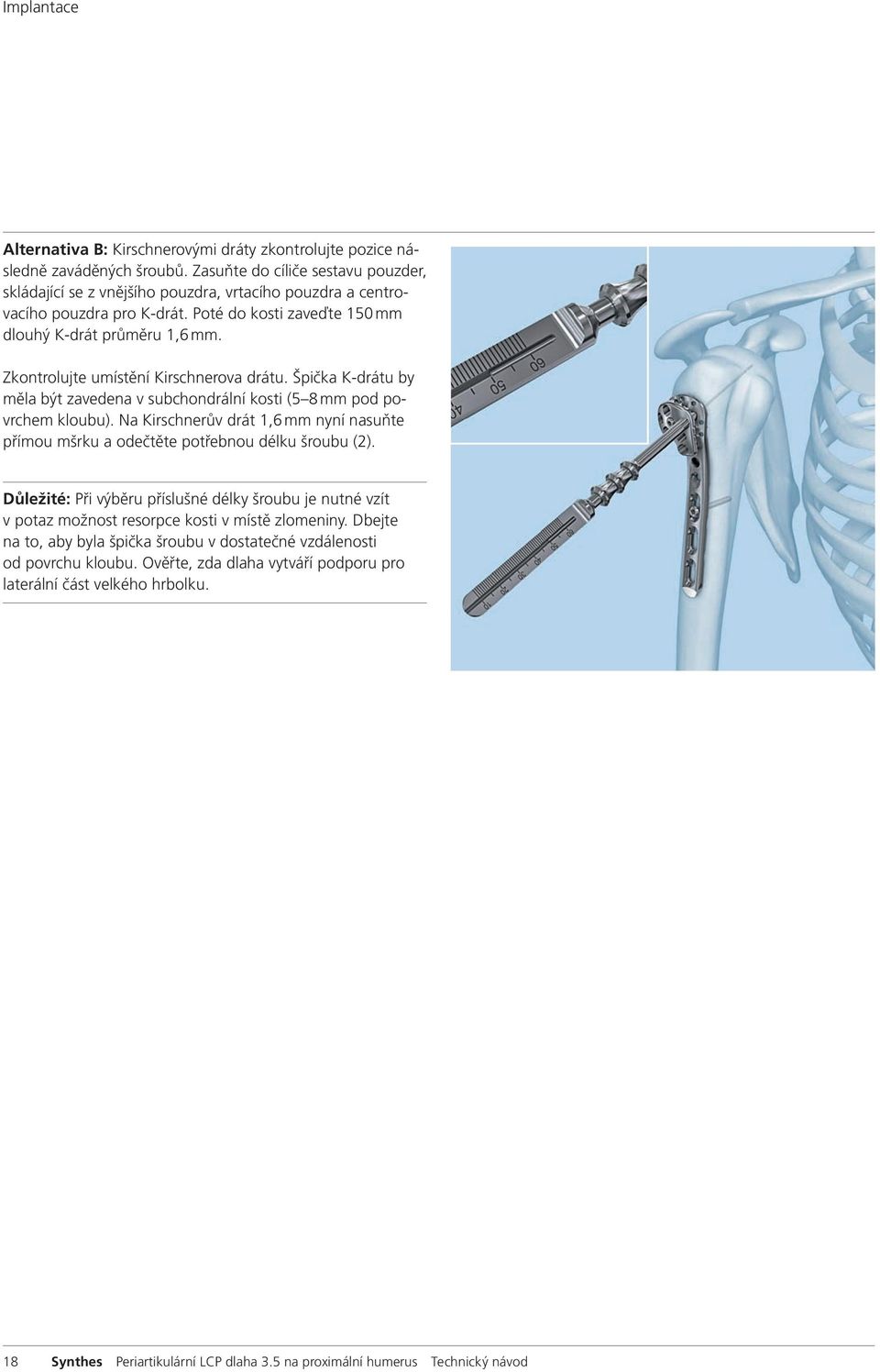 Zkontrolujte umístění Kirschnerova drátu. Špička K-drátu by měla být zavedena v subchondrální kosti (5 8 mm pod povrchem kloubu).