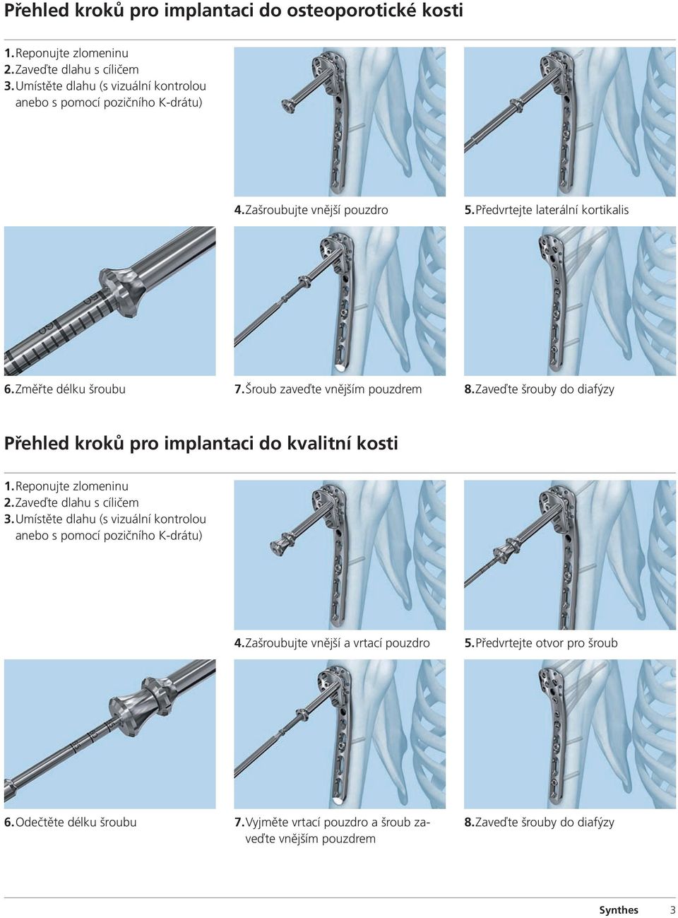 Šroub zaveďte vnějším pouzdrem 8. Zaveďte šrouby do diafýzy Přehled kroků pro implantaci do kvalitní kosti 1. Reponujte zlomeninu 2. Zaveďte dlahu s cíličem 3.