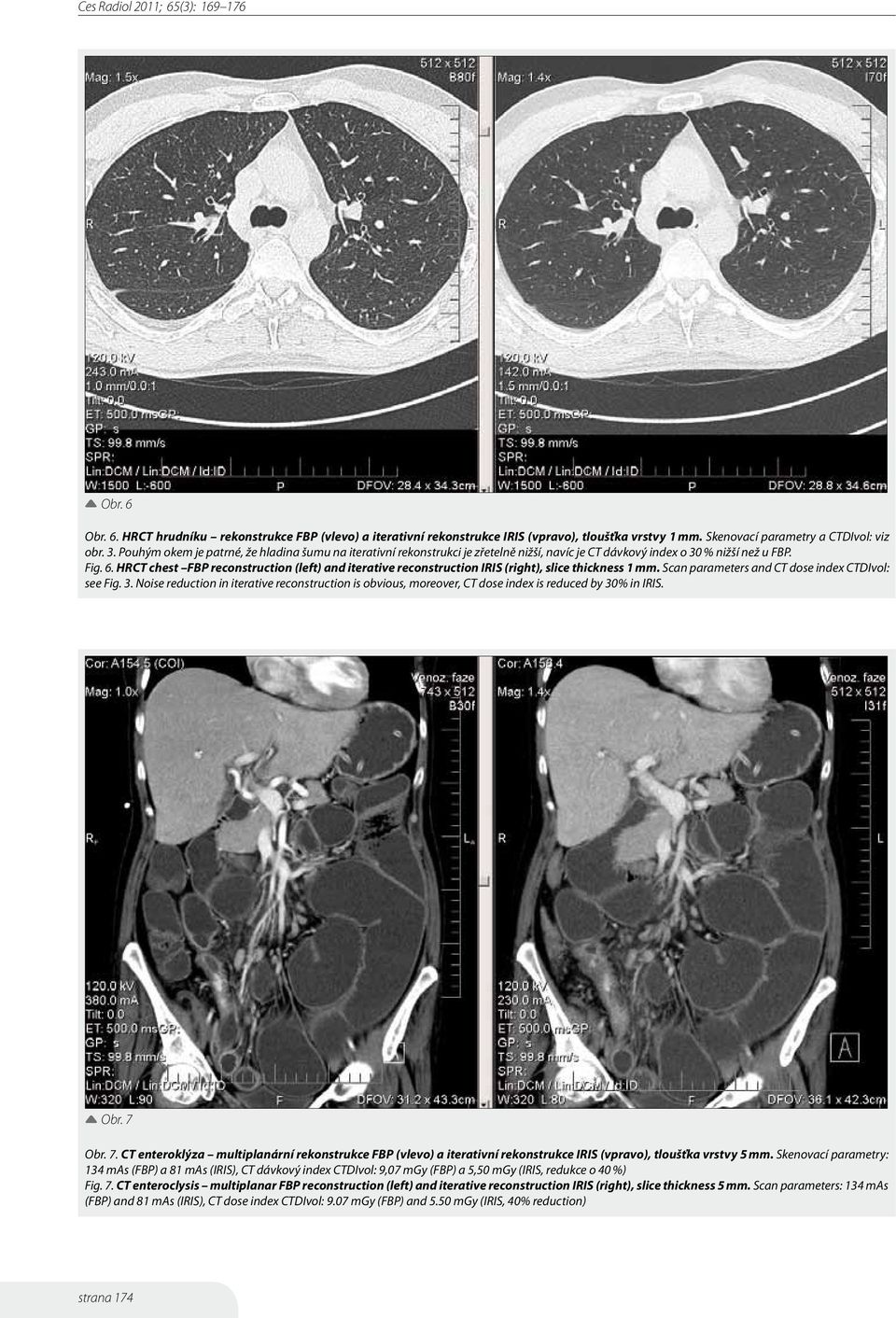 HRCT chest FBP reconstruction (left) and iterative reconstruction IRIS (right), slice thickness 1 mm. Scan parameters and CT dose index CTDIvol: see Fig. 3.