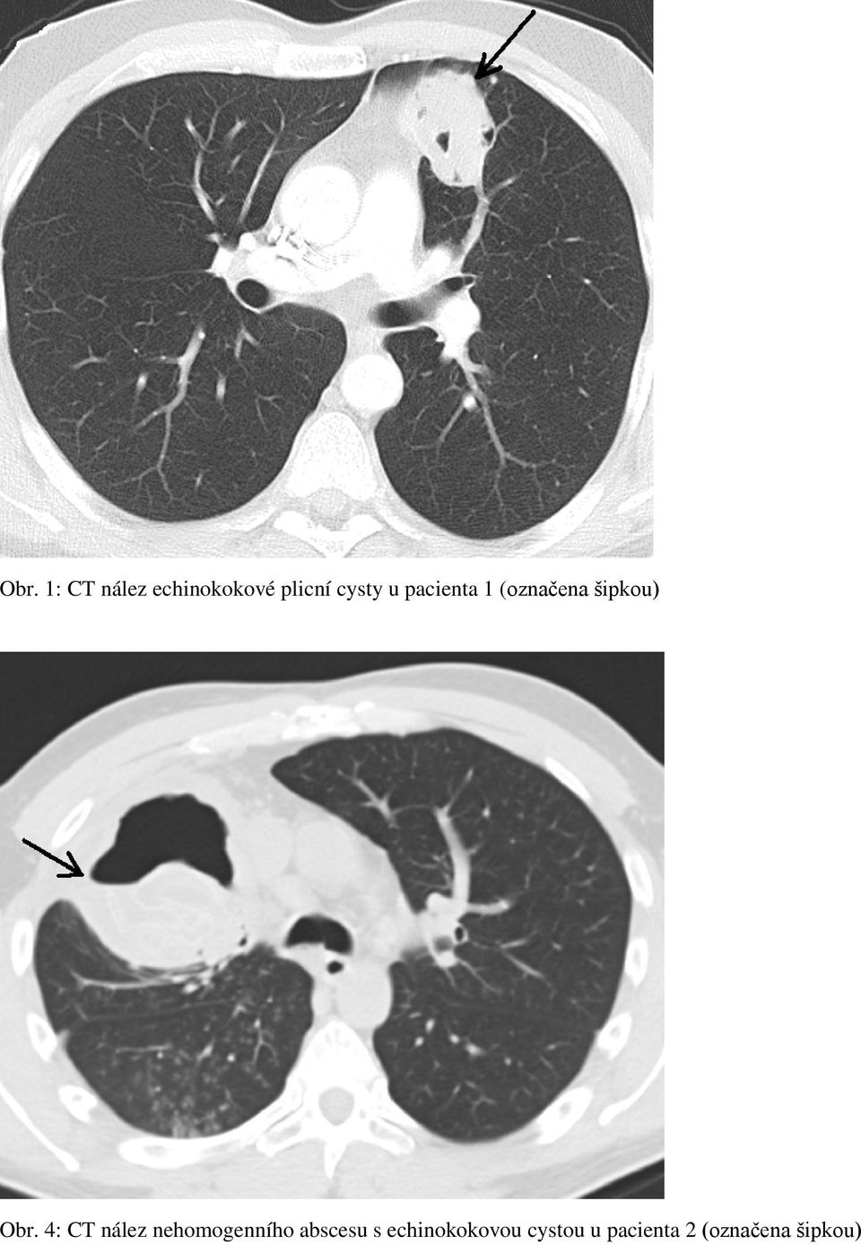 4: CT nález nehomogenního abscesu s