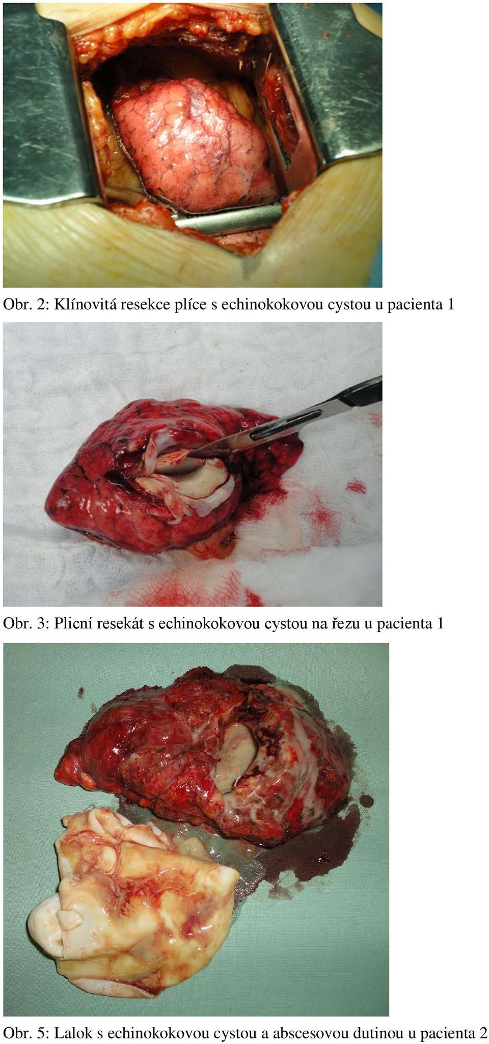 3: Plicní resekát s echinokokovou cystou na řezu u