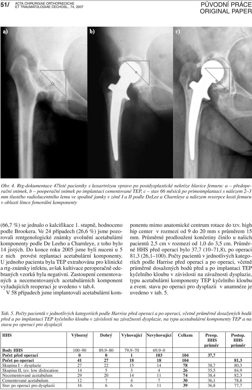 primoimplantaci s nálezem 2 3 mm tlustého radiolucentního lemu ve spodině jamky v zóně I a II podle DeLee a Charnleye a nálezem resorpce kosti femuru v oblasti límce femorální komponenty (66,7 %) se
