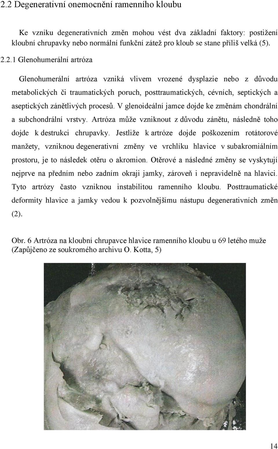 2.1 Glenohumerální artróza Glenohumerální artróza vzniká vlivem vrozené dysplazie nebo z důvodu metabolických či traumatických poruch, posttraumatických, cévních, septických a aseptických zánětlivých