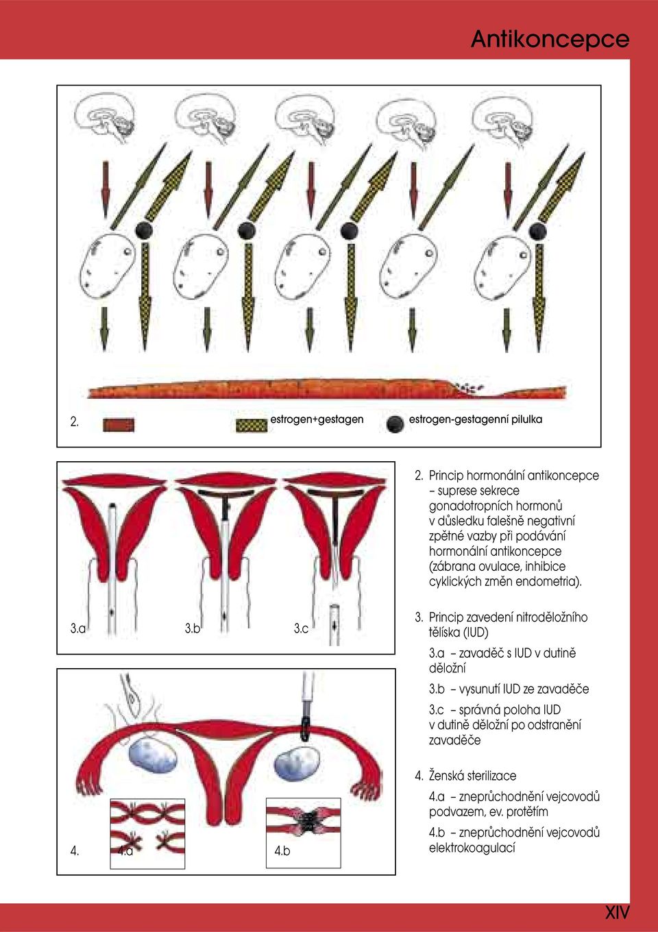 antikoncepce (zábrana ovulace, inhibice cyklických změn endometria). 3.a 3.b 3.c 3. Princip zavedení nitroděložního tělíska (IUD) 3.