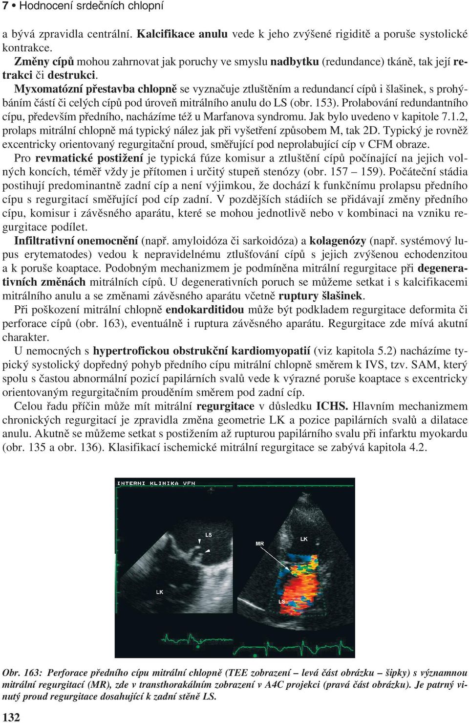 Myxomatózní přestavba chlopně se vyznačuje ztluštěním a redundancí cípů i šlašinek, s prohýbáním částí či celých cípů pod úroveň mitrálního anulu do LS (obr. 153).