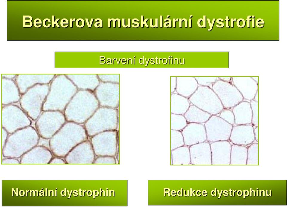 dystrofinu Normální