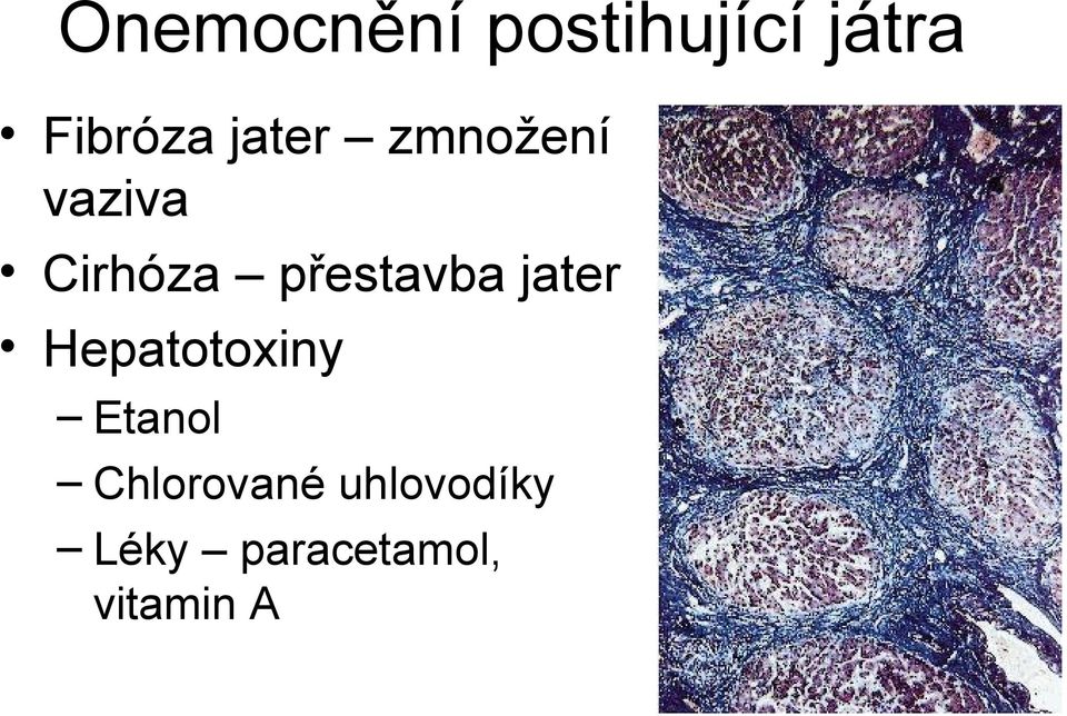 přestavba jater Hepatotoxiny Etanol