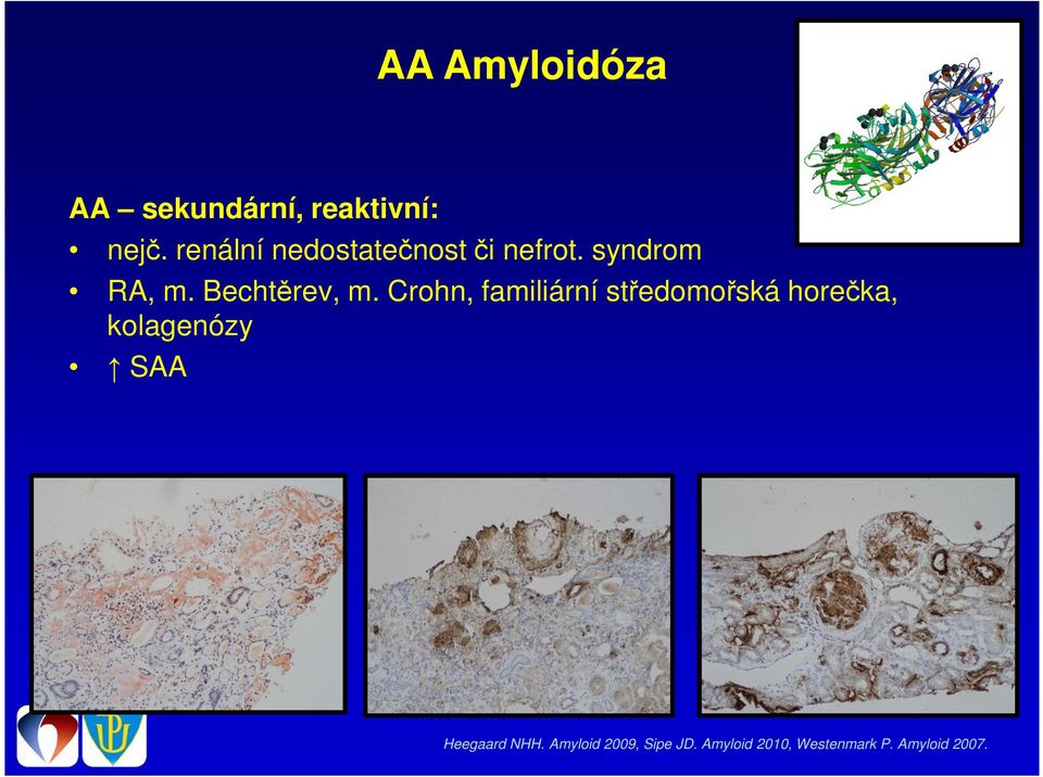 Amyloidóza diagnostické možnosti a diagnostický algoritmus Pika T., Ščudla  V. - PDF Free Download