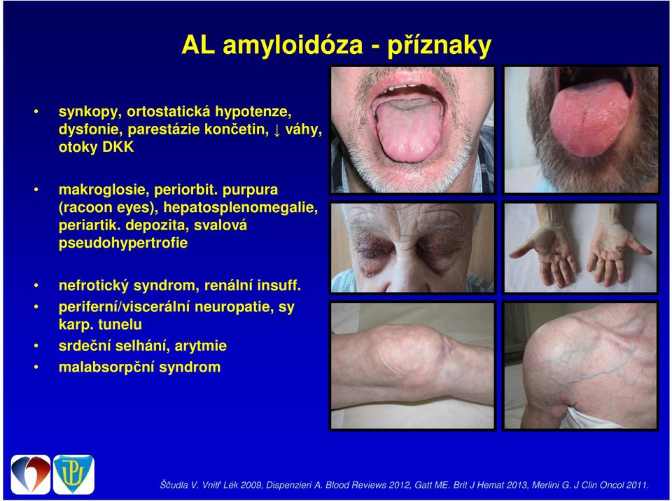 depozita, svalová pseudohypertrofie nefrotický syndrom, renální insuff. periferní/viscerální neuropatie, sy karp.