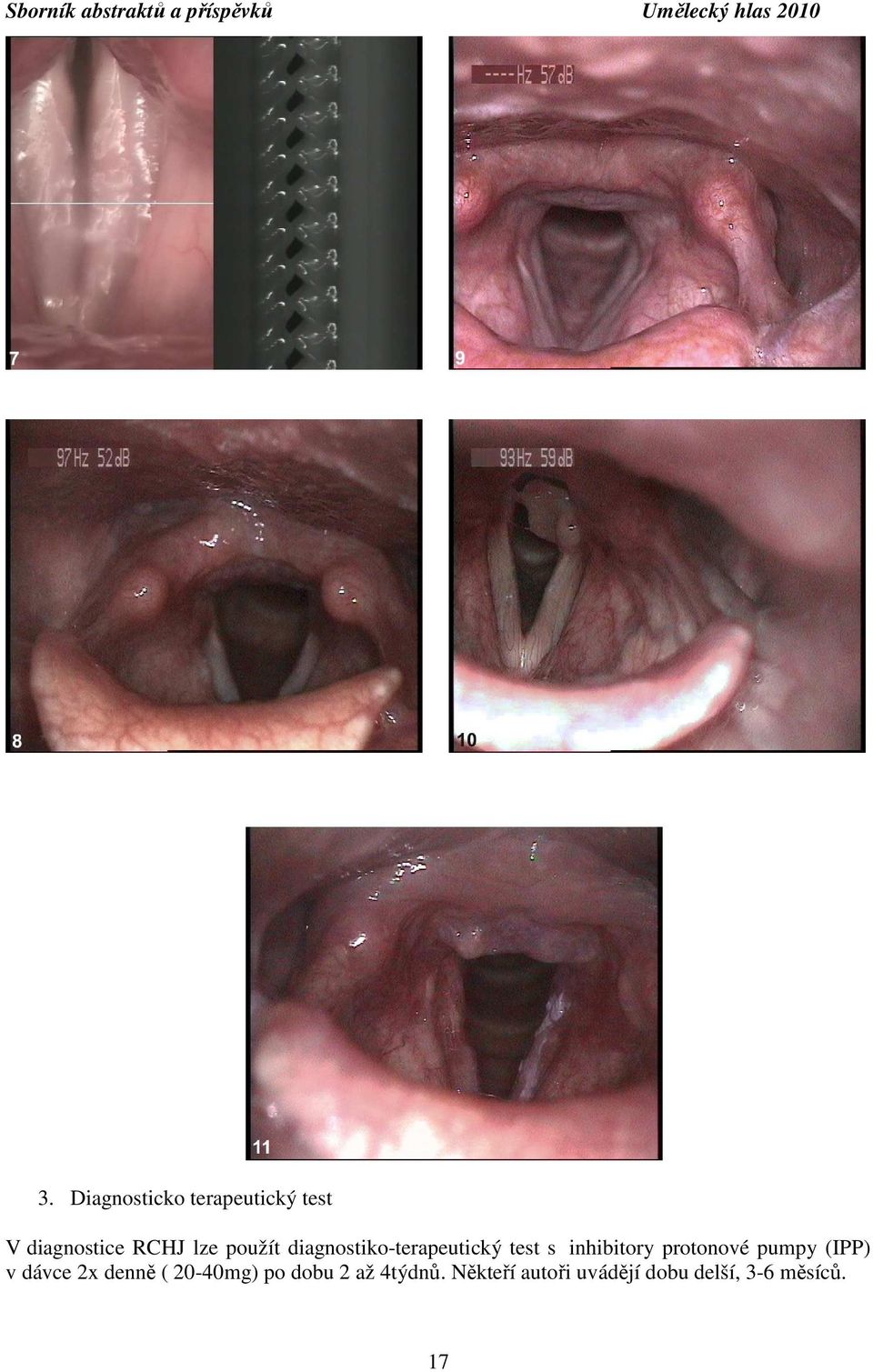 protonové pumpy (IPP) v dávce 2x denně ( 20-40mg) po