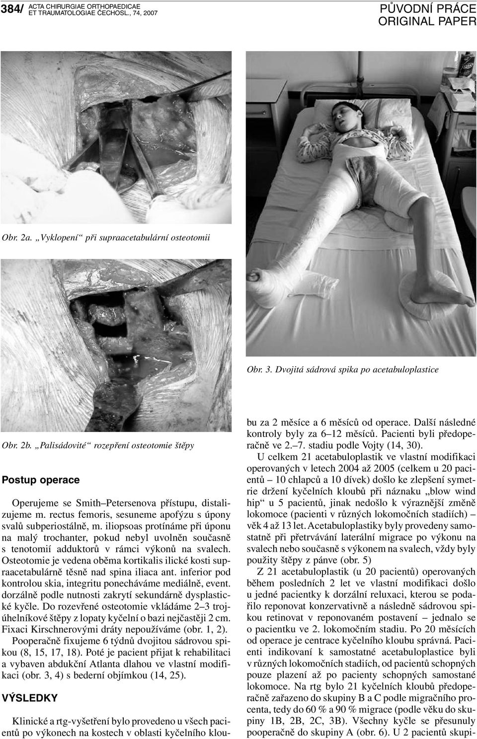 iliopsoas protínáme při úponu na malý trochanter, pokud nebyl uvolněn současně s tenotomií adduktorů v rámci výkonů na svalech.