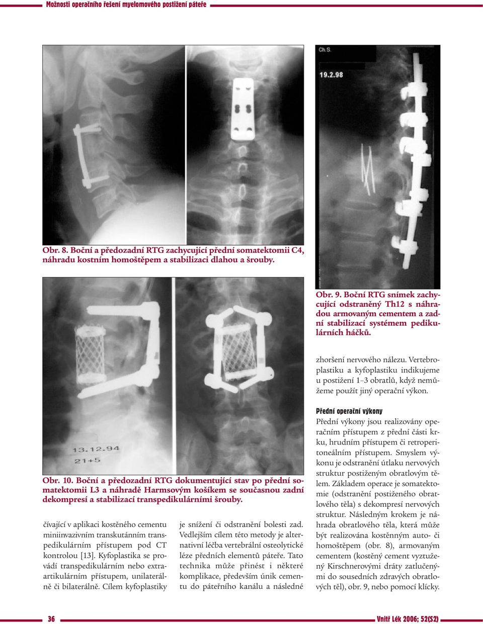 Vertebroplastiku a kyfoplastiku indikujeme u postižení 1 3 obratlů, když nemůžeme použít jiný operační výkon. Obr. 10.