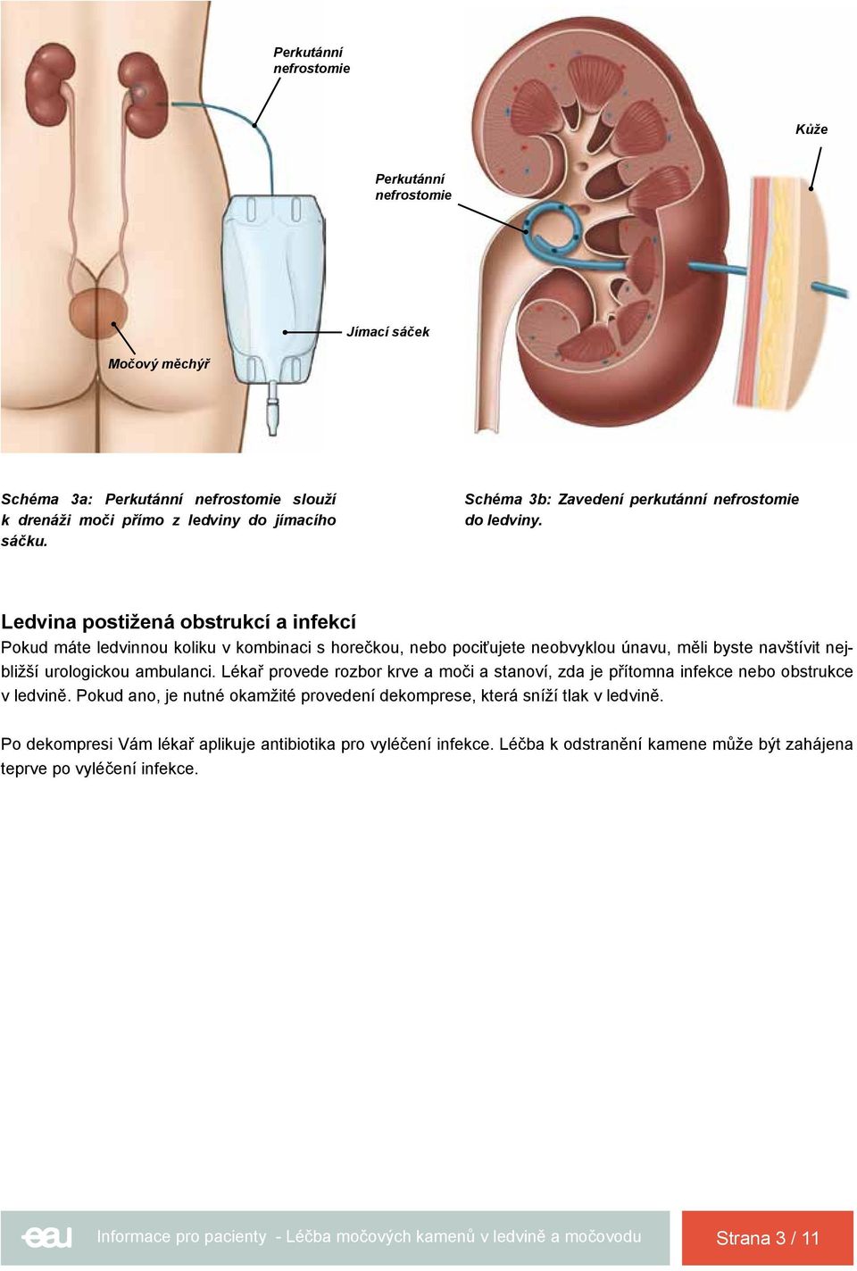 Ledvina postižená obstrukcí a infekcí Pokud máte ledvinnou koliku v kombinaci s horečkou, nebo pociťujete neobvyklou únavu, měli byste navštívit nejbližší urologickou ambulanci.